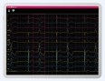 EKG aparat